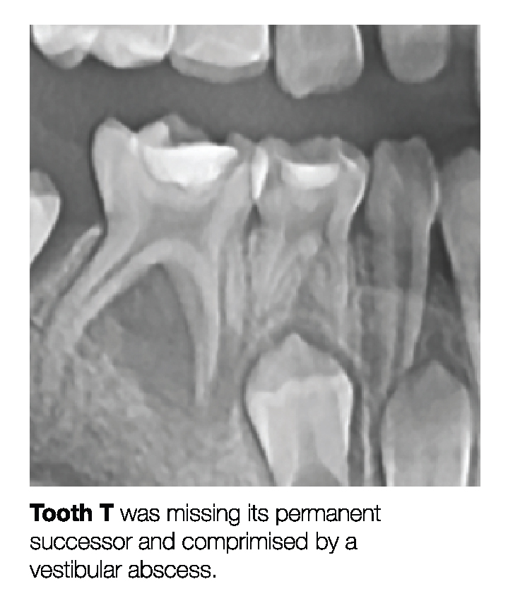 Making a Permanent Difference with Zirconia Crowns (5-Year Follow Up) 3