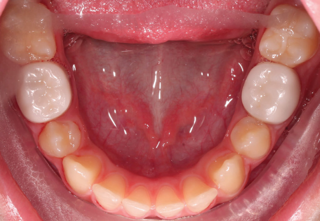Making a Permanent Difference with Zirconia Crowns (5-Year Follow Up) 11