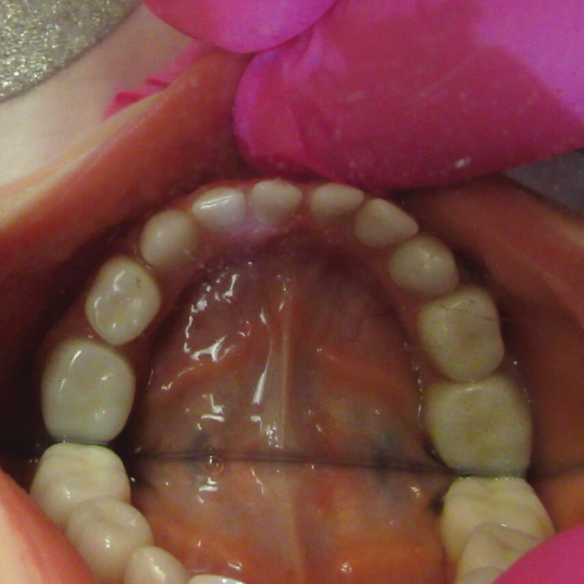 From Dentinogenesis Imperfecta to Zirconia Crown Perfection! 4