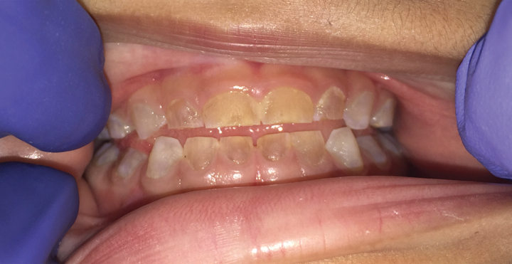 Dallas Duo Completes the First Full – Mouth Zirconia Crown Case 2