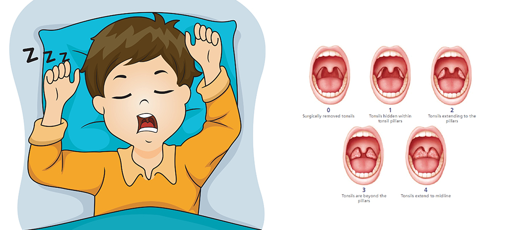 Obstructive Sleep Apnea in Pediatric Patients 1