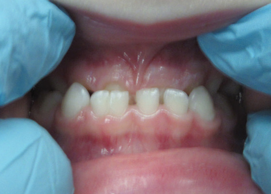 Treating Class 3 Malocclusions with Zirconia Crowns 4