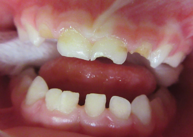 Treating Class 3 Malocclusions with Zirconia Crowns 3
