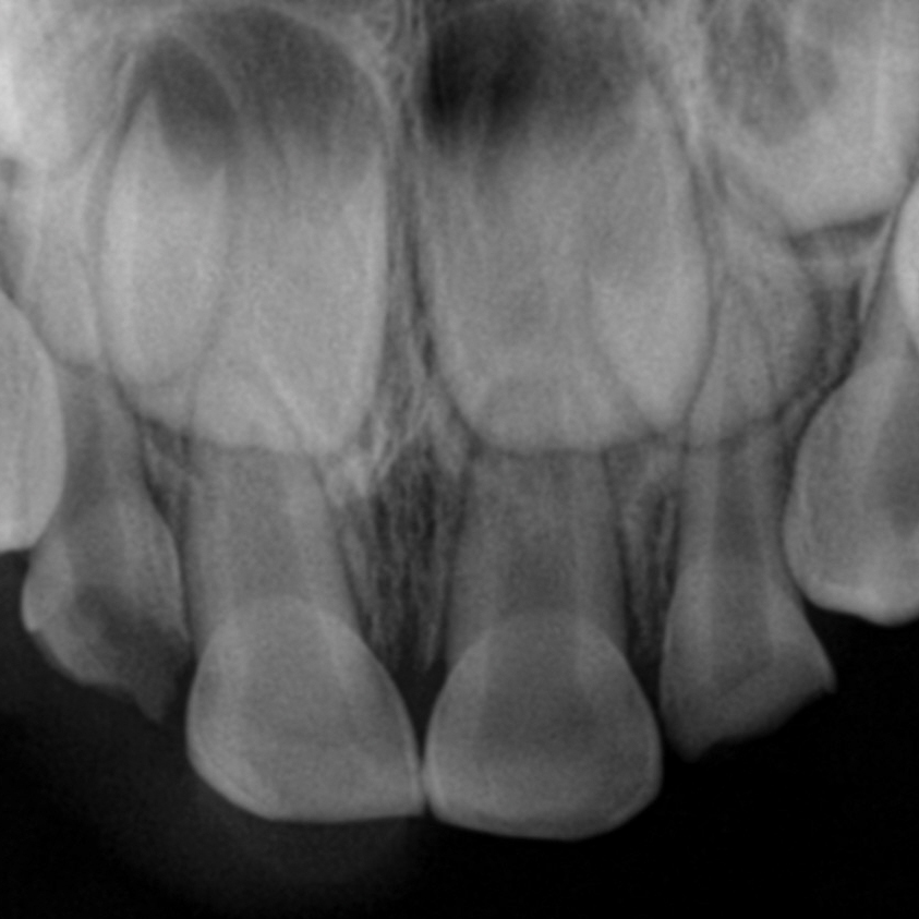 Treating Class 3 Malocclusions with Zirconia Crowns 2